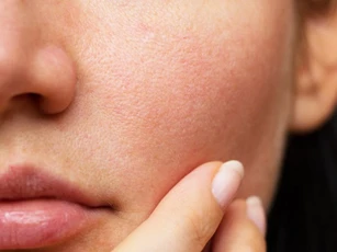 Thói quen xấu gây tắc lỗ chân lông