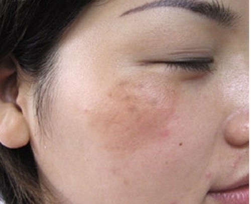 3 công thức giúp bạn tự làm kem trị nám da tại nhà