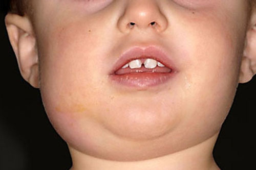 Bệnh quai bị và những điều bạn cần biết