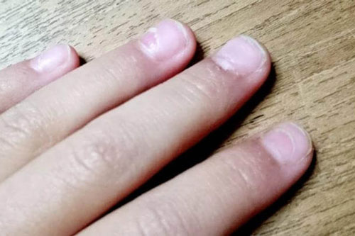 Bắt bệnh cho bé thông qua màu móng tay