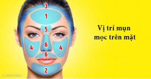 Vị trí mụn trên cơ thể cảnh báo bệnh gì?