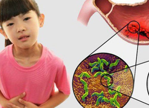 Con thủng dạ dày, tá tràng vì thói quen khi ăn của triệu gia đình Việt