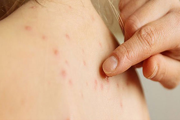 3 sai lầm "kiêng cữ" trong chăm sóc bệnh nhân thủy đậu cần bỏ ngay