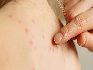 3 sai lầm "kiêng cữ" trong chăm sóc bệnh nhân thủy đậu cần bỏ ngay