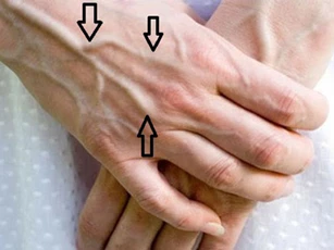 Gân xanh nổi lên chằng chịt ở những chỗ này cảnh báo căn bệnh nguy hiểm