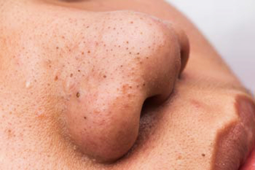 Chà chanh chấm muối lên mặt mụn bao nhiêu cũng bay hết