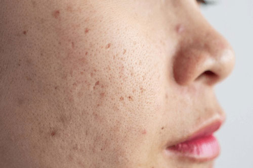 Mụn ẩn dưới da mùa hè điều trị thế nào?