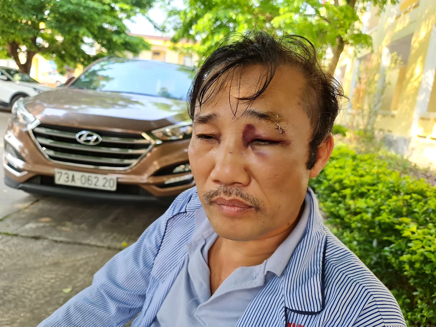 Kết quả chụp X- Quang chẩn đoán ông Nguyễn Ngọc Nhất bị vỡ xương mũi, chấn động, vết thương vùng mắt.