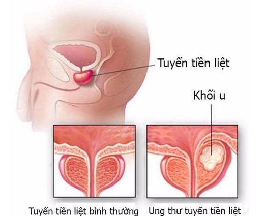 Nam giới có nguy cơ cao mắc top 10 căn bệnh ung thư này