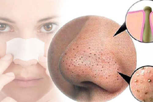 Bí quyết nặn mụn đầu đen hiệu quả không kém đi Spa