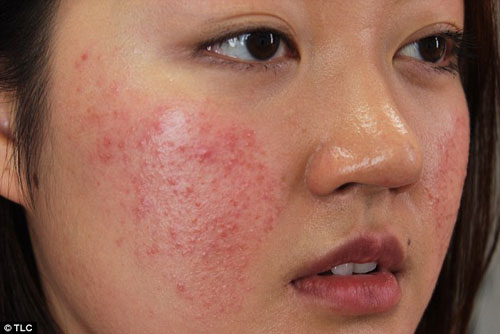 Mách bạn cách xử lý khi da bị dị ứng mỹ phẩm