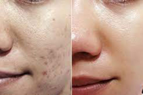 Mẹo hay khiến vết thâm do mụn biến mất chỉ sau 1 đêm