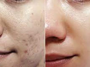 Mẹo hay khiến vết thâm do mụn biến mất chỉ sau 1 đêm