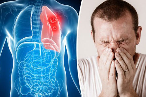 Thấy 5 dấu hiệu này, hãy cảnh giác vì phổi đang "tích độc", nhanh chân đi khám ngay