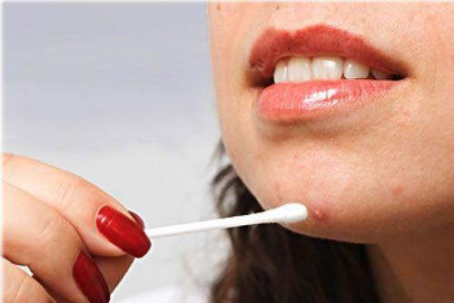 Mẹo sạch mụn trứng cá chỉ trong 1 đêm