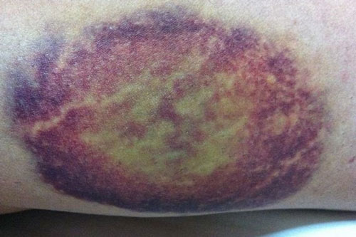 Thấy dấu hiệu này hãy tới bệnh viện ngay kẻo chết vì ung thư giai đoạn cuối