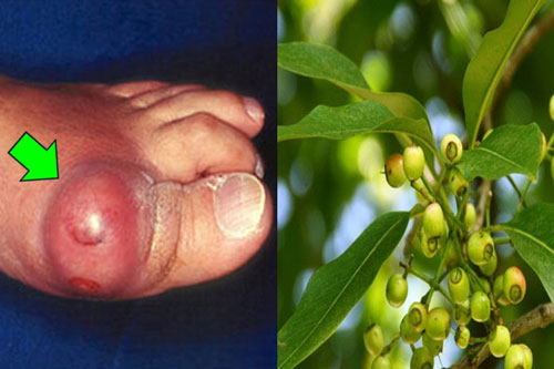 Khỏi hẳn bệnh Gout kinh niên chỉ sau 1 tháng bằng thứ nước uống cực rẻ tiền và dễ làm này