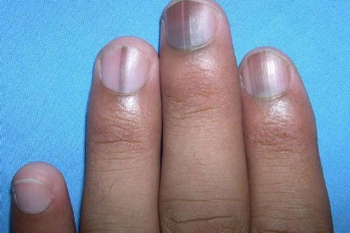 Thấy móng tay xuất hiện dấu hiệu này, cảnh báo căn bệnh nguy hiểm đang "đứng chờ" trước cửa