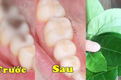 Trị dứt điểm sâu răng, viêm lợi, hôi miệng bằng loại lá rẻ bèo vườn nào cũng có, chợ nào cũng bán