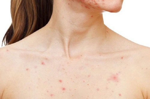 Giải quyết mụn trứng cá ở ngực đơn giản