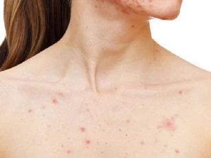 Giải quyết mụn trứng cá ở ngực đơn giản