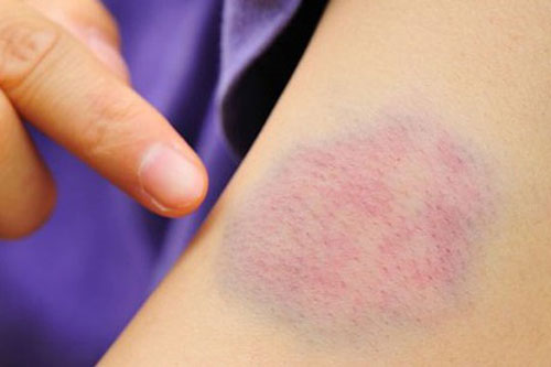 Nguyên nhân khiến da bị bầm tím bạn không ngờ được