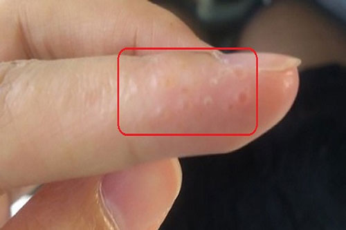Khi thấy tay có mụn nước thế này nhớ đi khám ngay lập tức