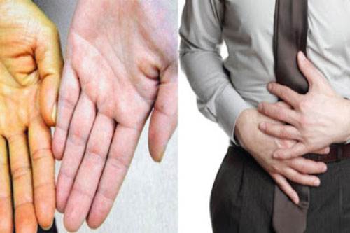 5 dấu hiệu chứng tỏ bạn mắc bệnh gan, cần đi khám bác sĩ khẩn cấp