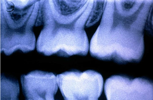 Men răng tiến hóa từ vẩy cá cổ đại?