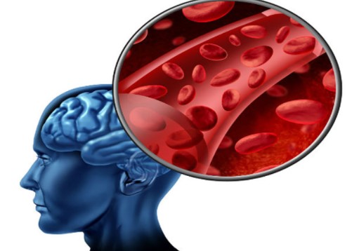 Tại sao đột quỵ xảy ra nhiều ở phụ nữ?