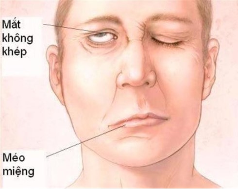 Top 10 dấu hiệu cảnh báo nguy cơ đột quỵ mà bạn nên biết