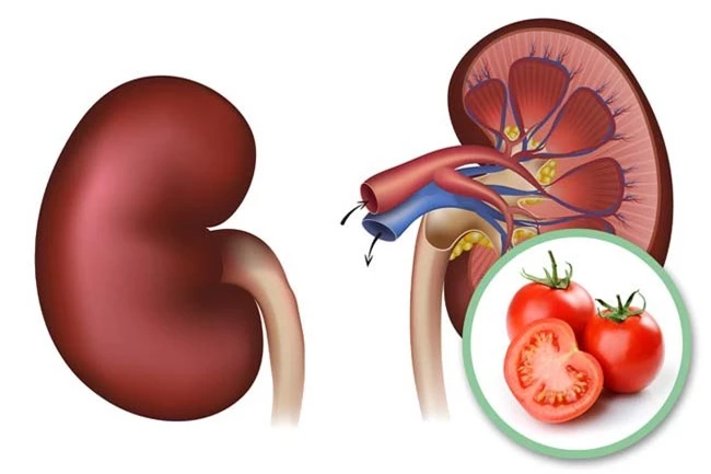 Người mắc bệnh sỏi thận