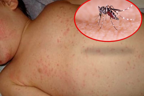 Bị sốt xuất huyết hãy ăn món này, khỏi bệnh cực nhanh và ngừa biến chứng rất tốt