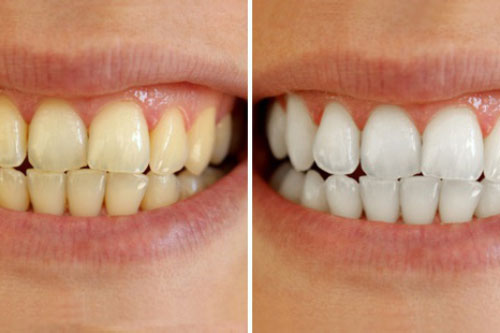 Cao răng tróc ra từng mảng, răng ố vàng đến mấy cũng trắng như bọc sứ chỉ với nguyên liệu vài nghìn này!