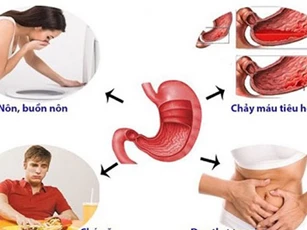 Những dấu hiệu cảnh báo đau dạ dày, rất nhiều người mắc bệnh mà không biết