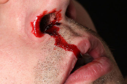 Chết lúc nào không hay vì chủ quan khi bị chảy máu cam