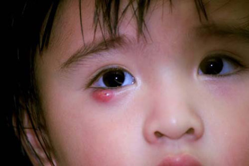 Cách chữa lẹo mắt thần tốc tại nhà không để lại sẹo