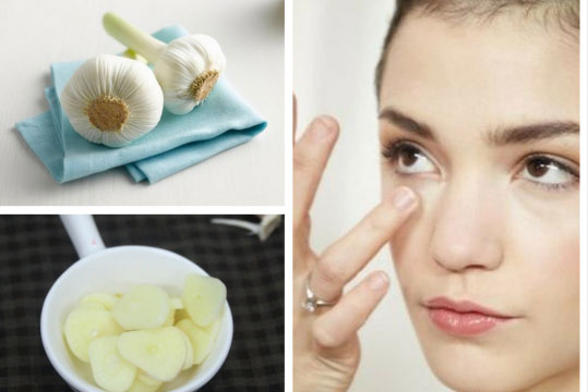 Hết ngay mụn thịt chỉ với 1 củ tỏi