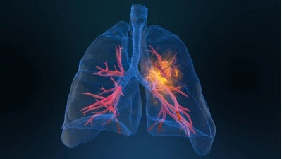 U phổi là bệnh lý nguy hiểm.