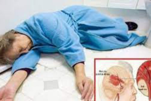 8 triệu chứng tưởng nhẹ thường bị bỏ qua nhưng lại cảnh báo đột quỵ ở phụ nữ