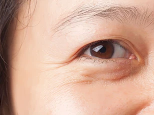 4 cách xử lý bọng mắt nhanh nhất