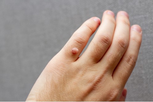 Top 6 cách đánh bay mụn cóc đơn giản, dễ làm tại nhà