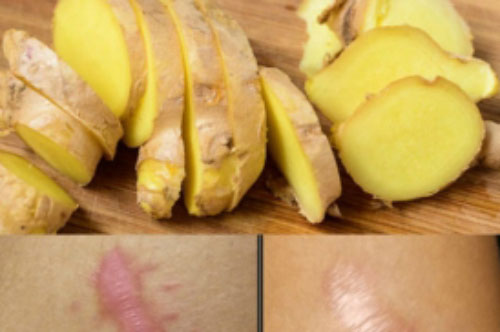 Đánh bay sẹo lồi - lõm chỉ nhờ 1 nhánh Gừng