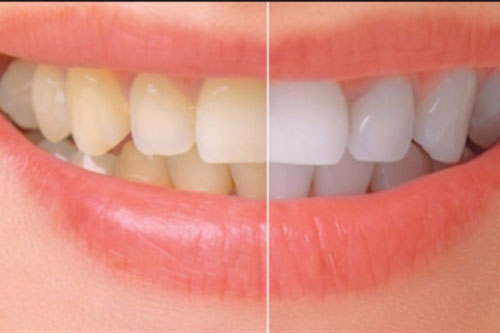 Giúp bạn làm trắng răng tại nhà với 2 công thức đơn giản