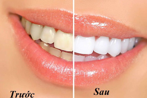 Mẹo nhỏ giúp bạn loại bỏ vết ố vàng trên răng