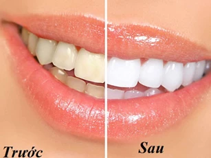 Mẹo nhỏ giúp bạn loại bỏ vết ố vàng trên răng