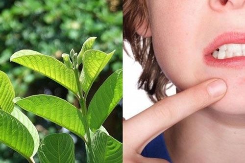 Trị mụn trứng cá trong mùa hè với lá ổi