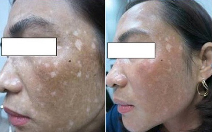 Da loang lổ chỉ vì làm đẹp với lá trầu không