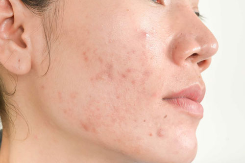 4 nguyên tắc "vàng" để hết thâm mụn ngay tại nhà