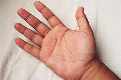 "1 lồi, 2 đỏ, 2 đau'' cảnh báo ung thư gan: Dấu hiệu không thể nhầm, đi khám ngay còn kịp